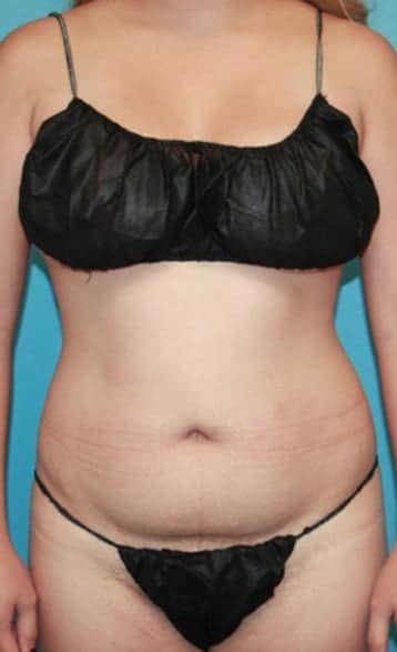 Plastic surgery patient results gallery - Dr. Cat Beverly Hills