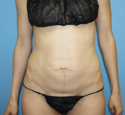 Plastic surgery patient results gallery - Dr. Cat Beverly Hills