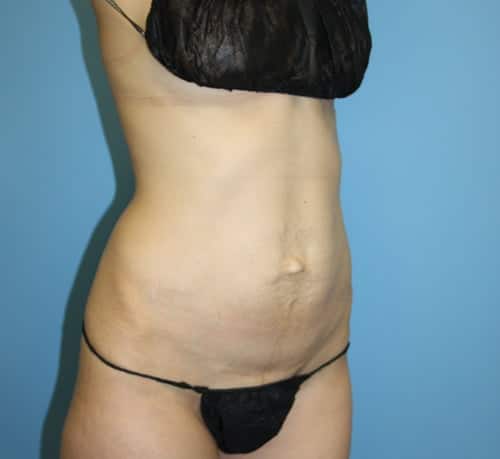 Plastic surgery patient results gallery - Dr. Cat Beverly Hills