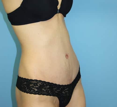 Plastic surgery patient results gallery - Dr. Cat Beverly Hills