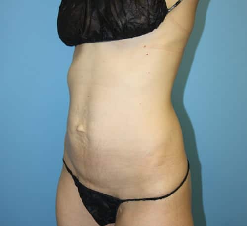 Plastic surgery patient results gallery - Dr. Cat Beverly Hills