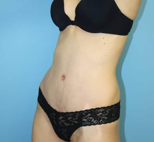 Plastic surgery patient results gallery - Dr. Cat Beverly Hills