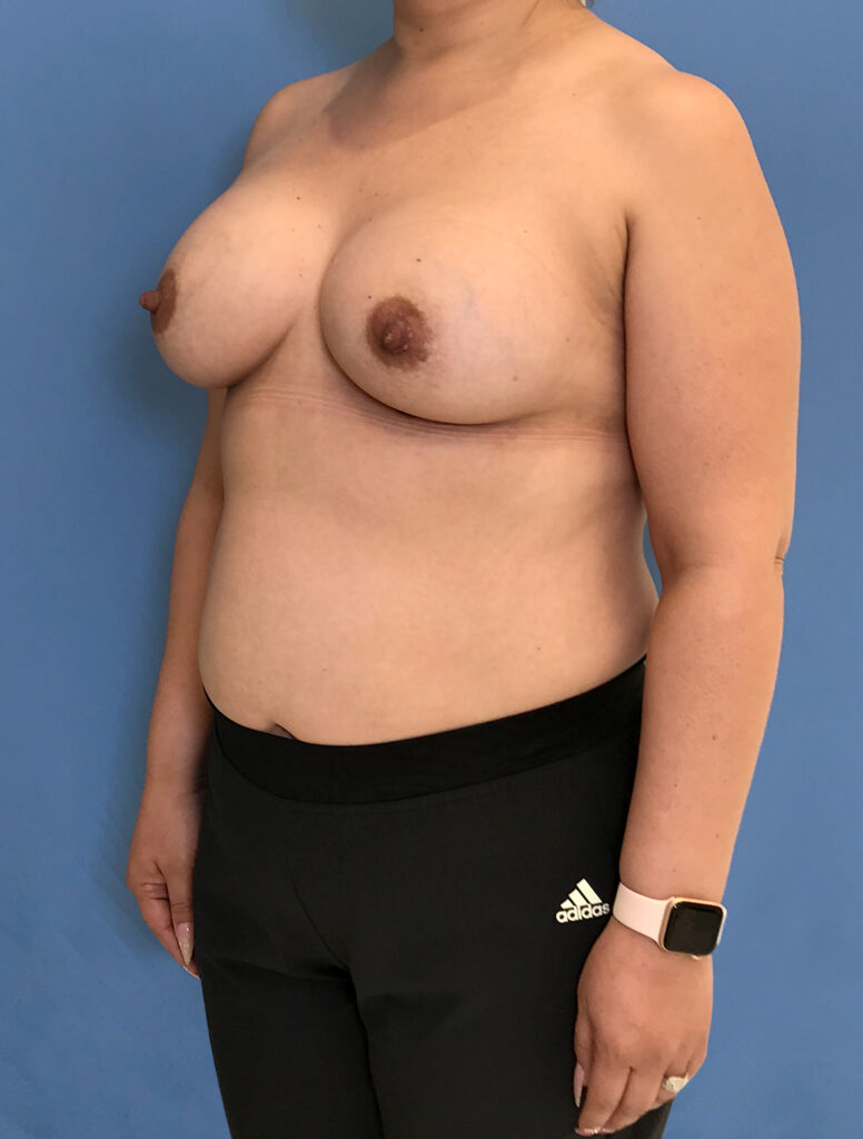 Case BAI-0776 after photo — Dr. Cat, Beverly Hills