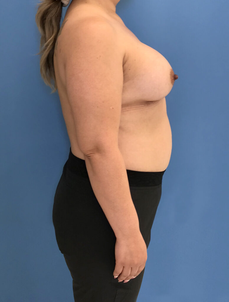 Case BAI-0776 after photo — Dr. Cat, Beverly Hills