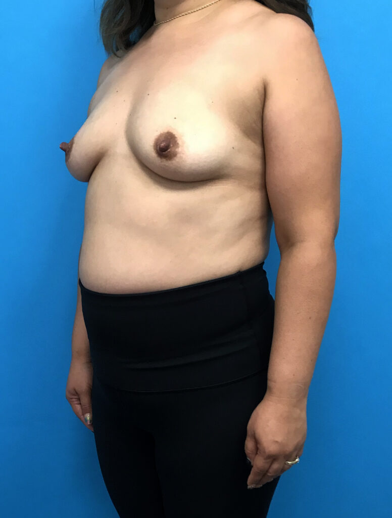 Case BAI-0776 before photo — Dr. Cat, Beverly Hills