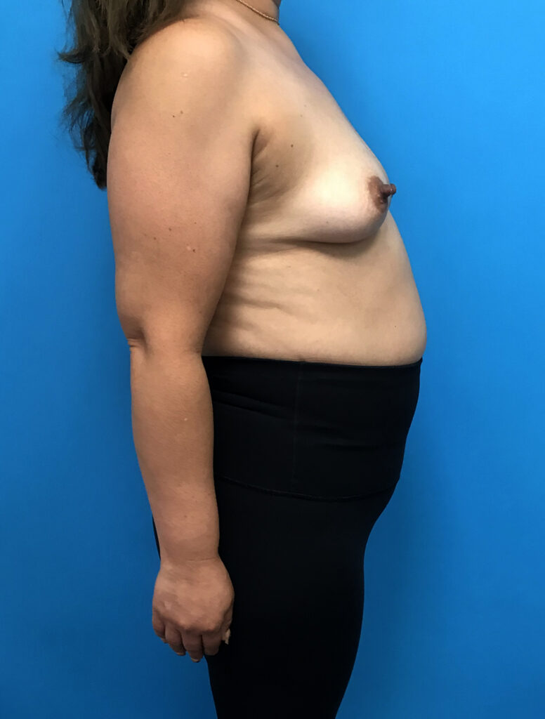 Case BAI-0776 before photo — Dr. Cat, Beverly Hills