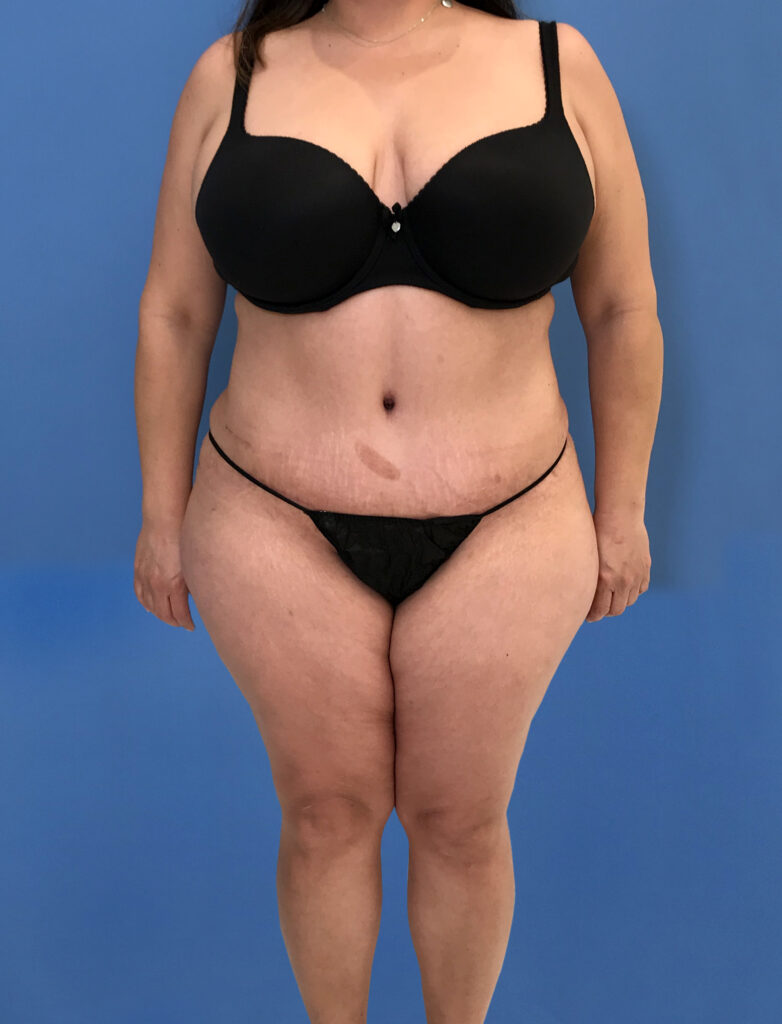 Case TTK-0790 after photo — Dr. Cat, Beverly Hills