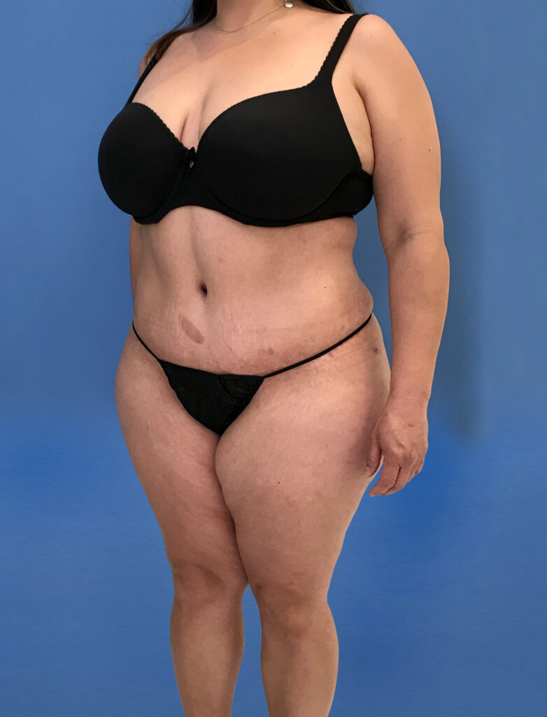 Case TTK-0790 after photo — Dr. Cat, Beverly Hills