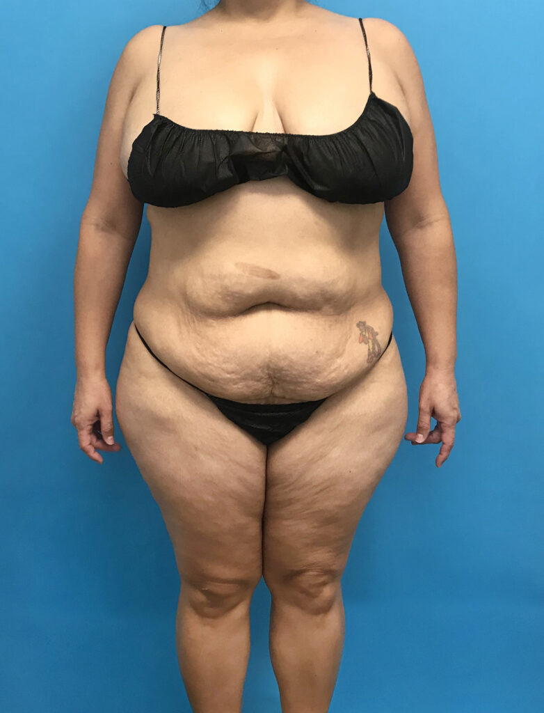 Case TTK-0790 before photo — Dr. Cat, Beverly Hills