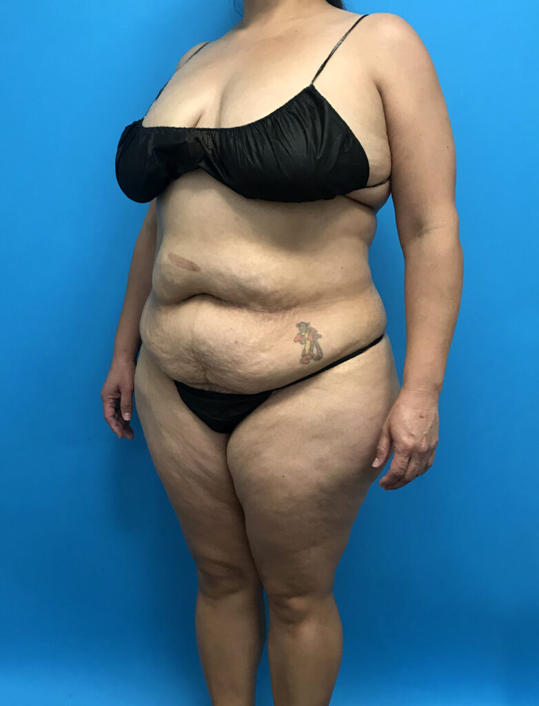 Case TTK-0790 before photo — Dr. Cat, Beverly Hills