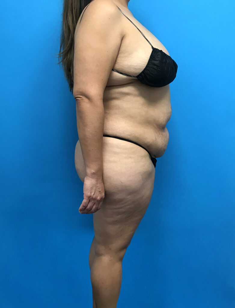 Case TTK-0790 before photo — Dr. Cat, Beverly Hills