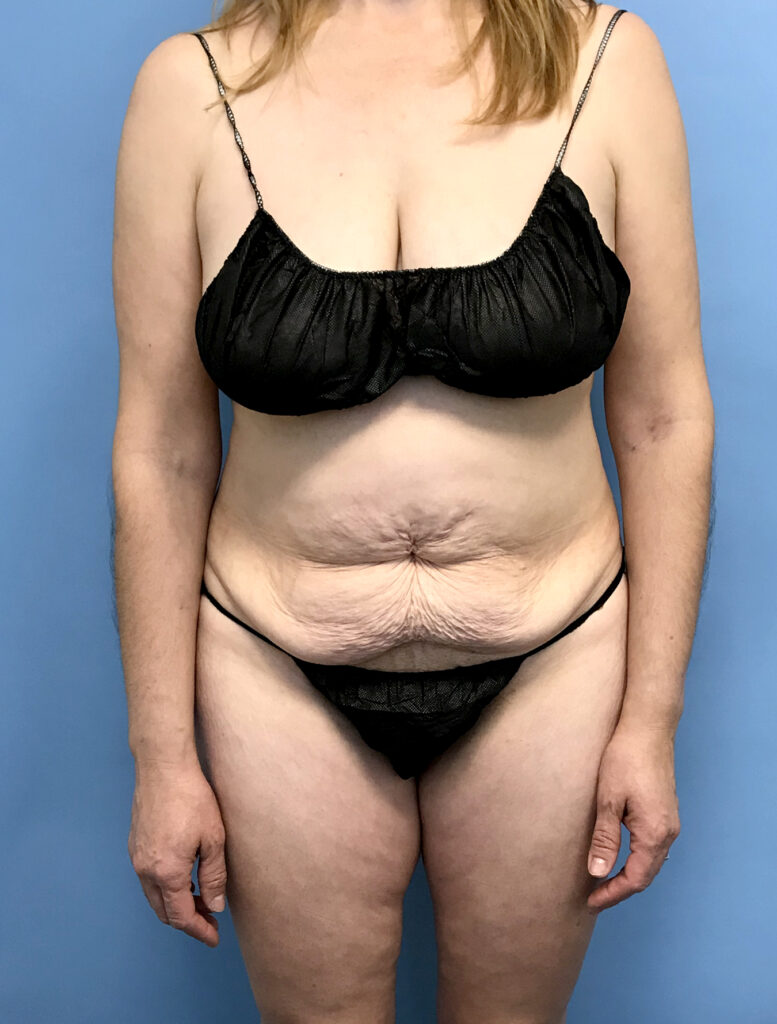 Case TTK-0801 before photo — Dr. Cat, Beverly Hills