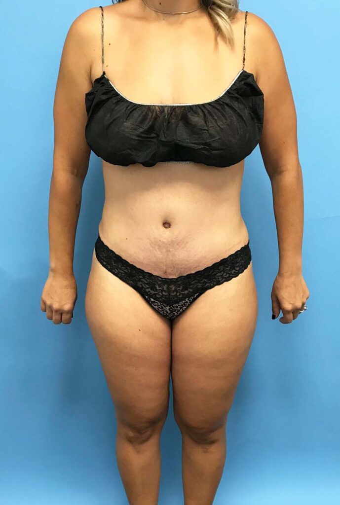 Case TTK-0449 after photo — Dr. Cat, Beverly Hills