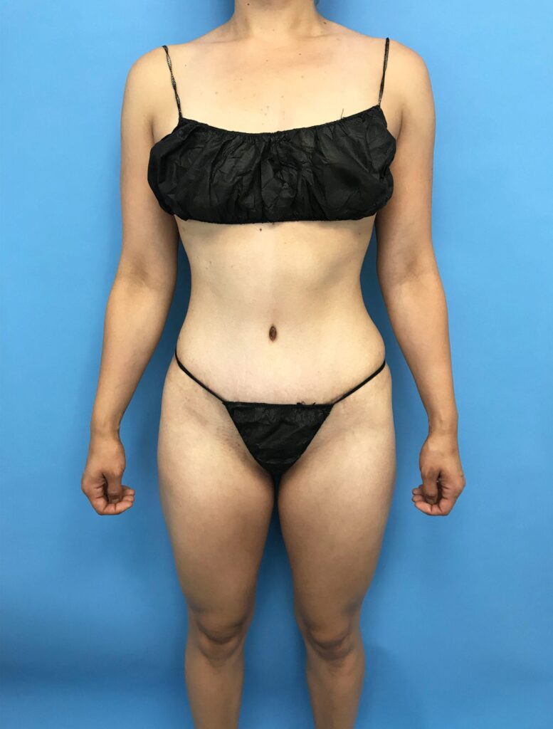 Case TTK-0548 after photo — Dr. Cat, Beverly Hills