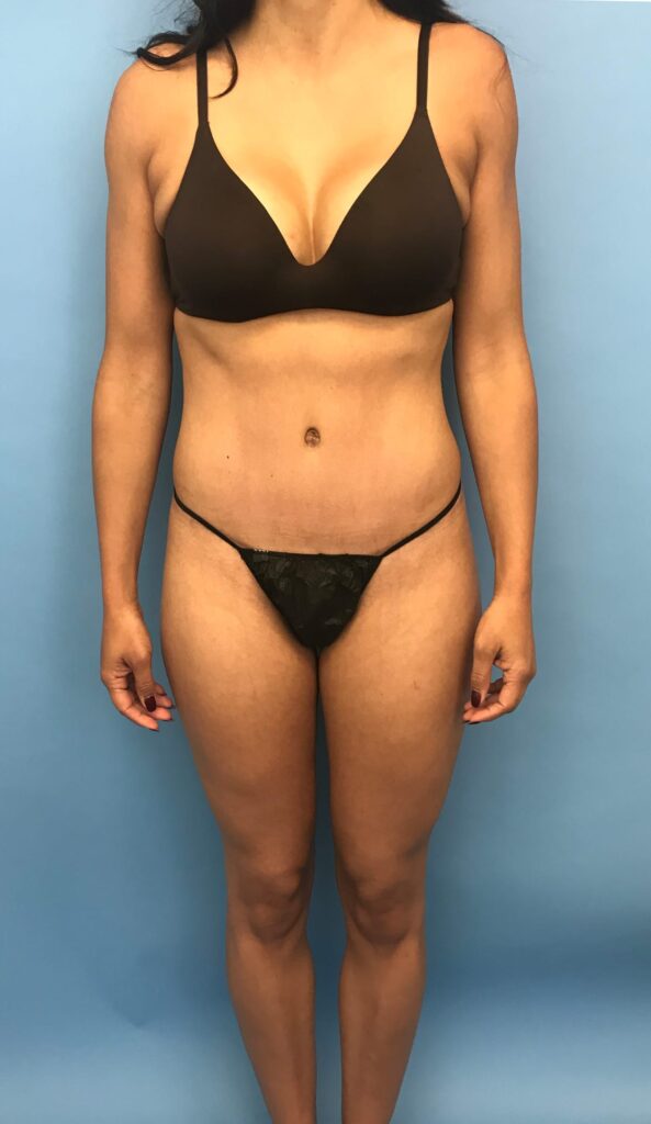 Case TTK-0506 after photo — Dr. Cat, Beverly Hills