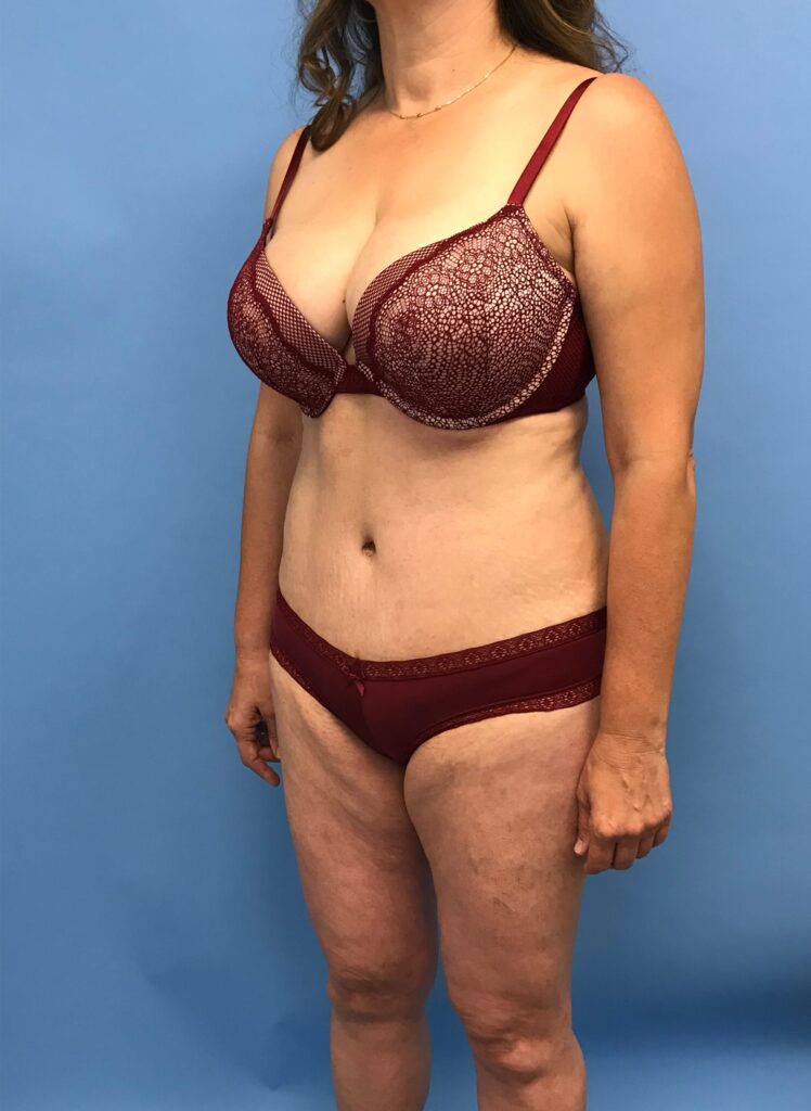 Case TTK-0484 after photo — Dr. Cat, Beverly Hills