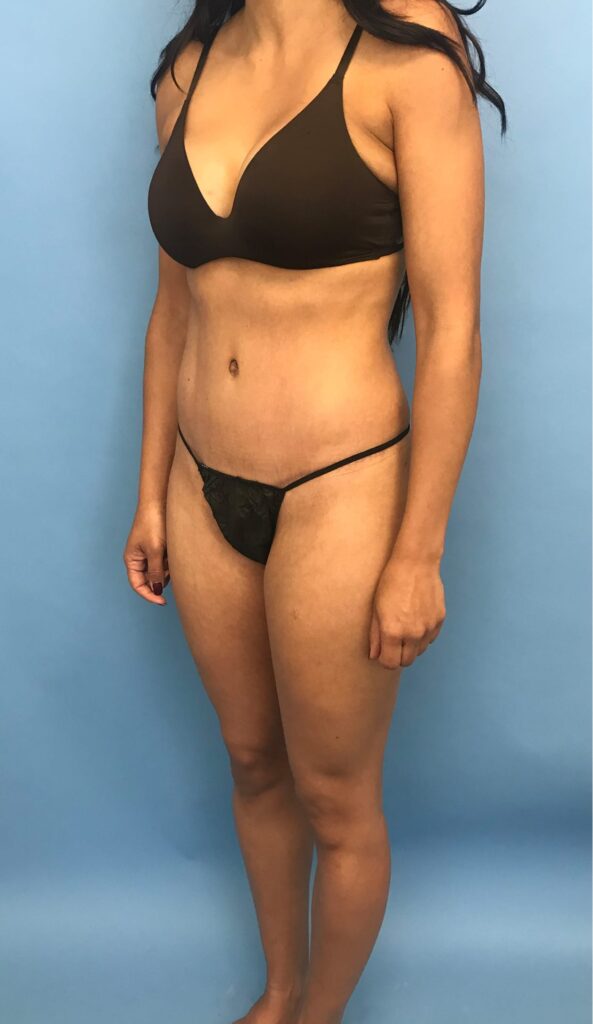 Case TTK-0506 after photo — Dr. Cat, Beverly Hills