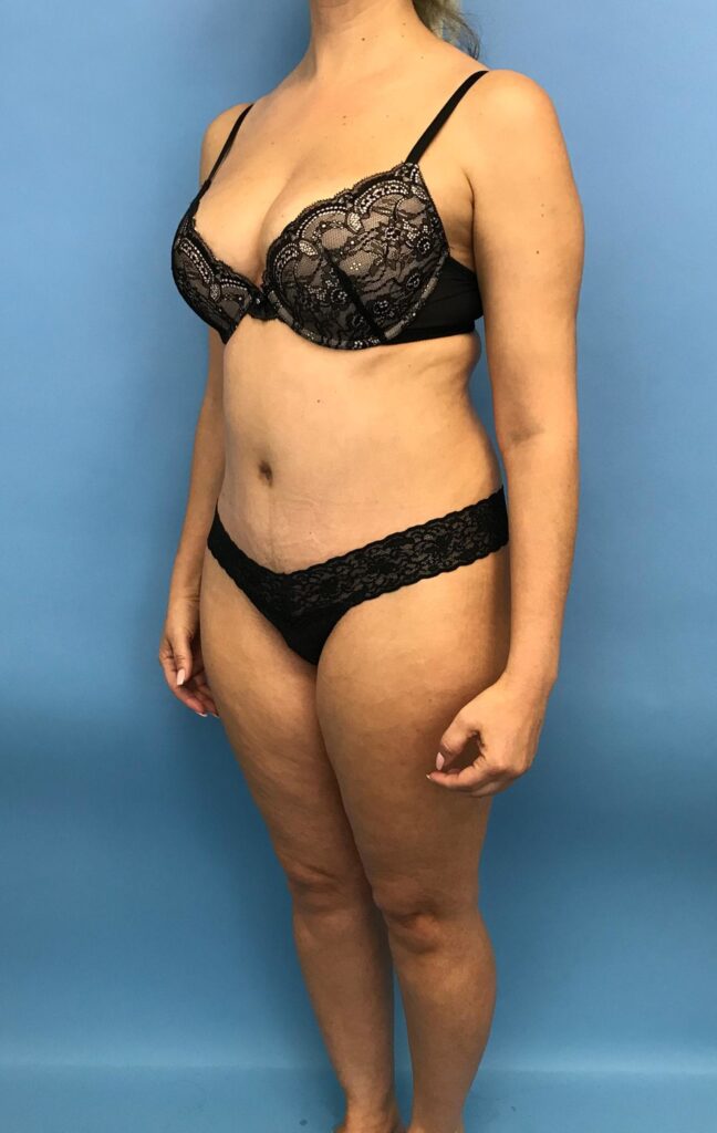Case TTK-0488 after photo — Dr. Cat, Beverly Hills