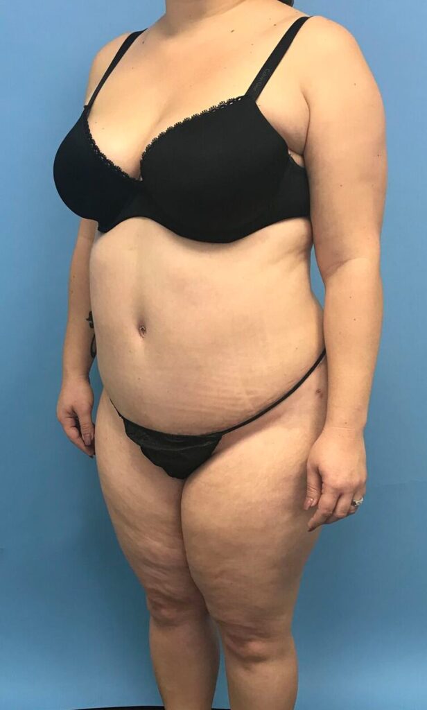 Case TTK-0493 after photo — Dr. Cat, Beverly Hills