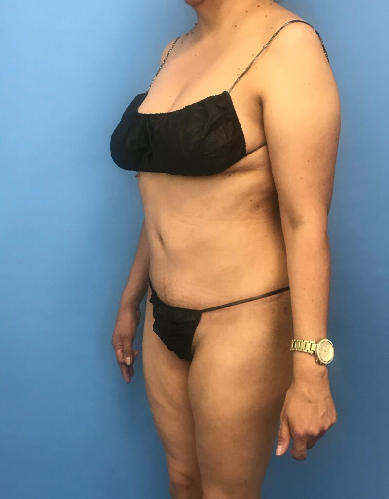 Case RTK-0528 after photo — Dr. Cat, Beverly Hills