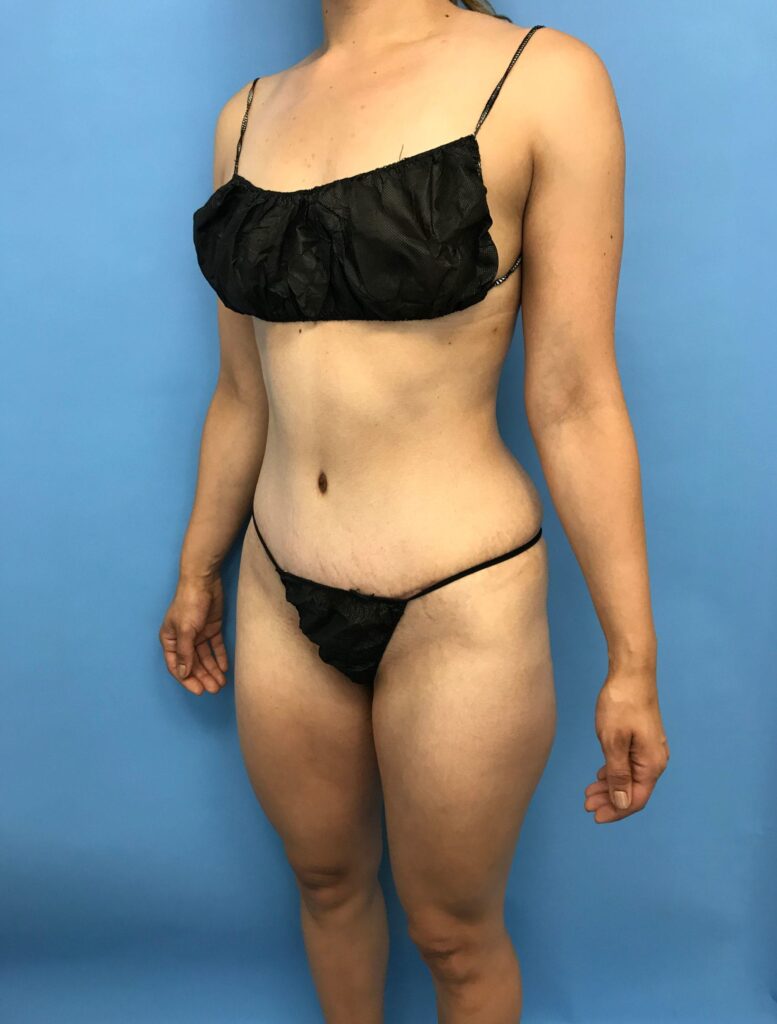 Case TTK-0548 after photo — Dr. Cat, Beverly Hills