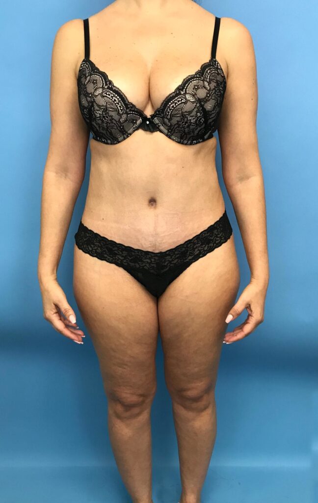 Case TTK-0488 after photo — Dr. Cat, Beverly Hills