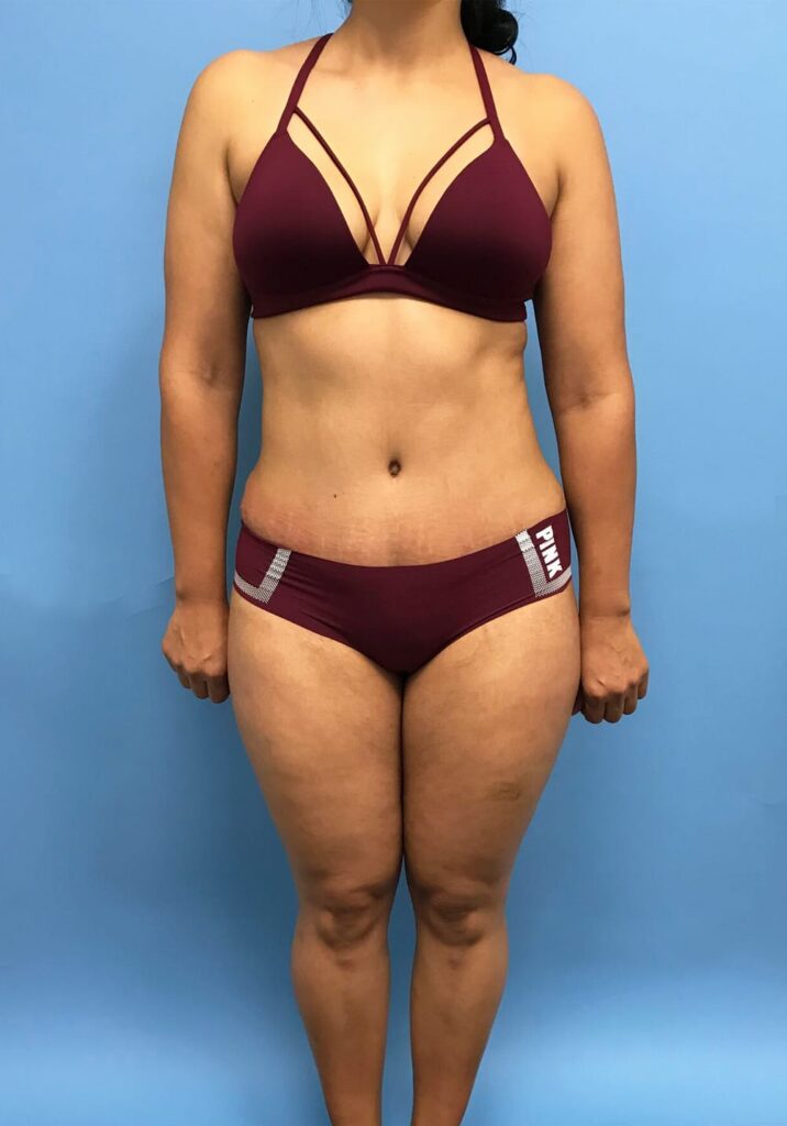 Case TTK-0440 after photo — Dr. Cat, Beverly Hills