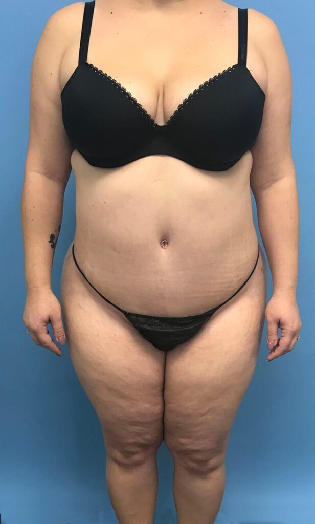 Case TTK-0493 after photo — Dr. Cat, Beverly Hills