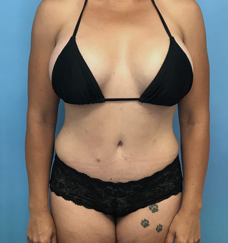 Case TTK-0348 after photo — Dr. Cat, Beverly Hills
