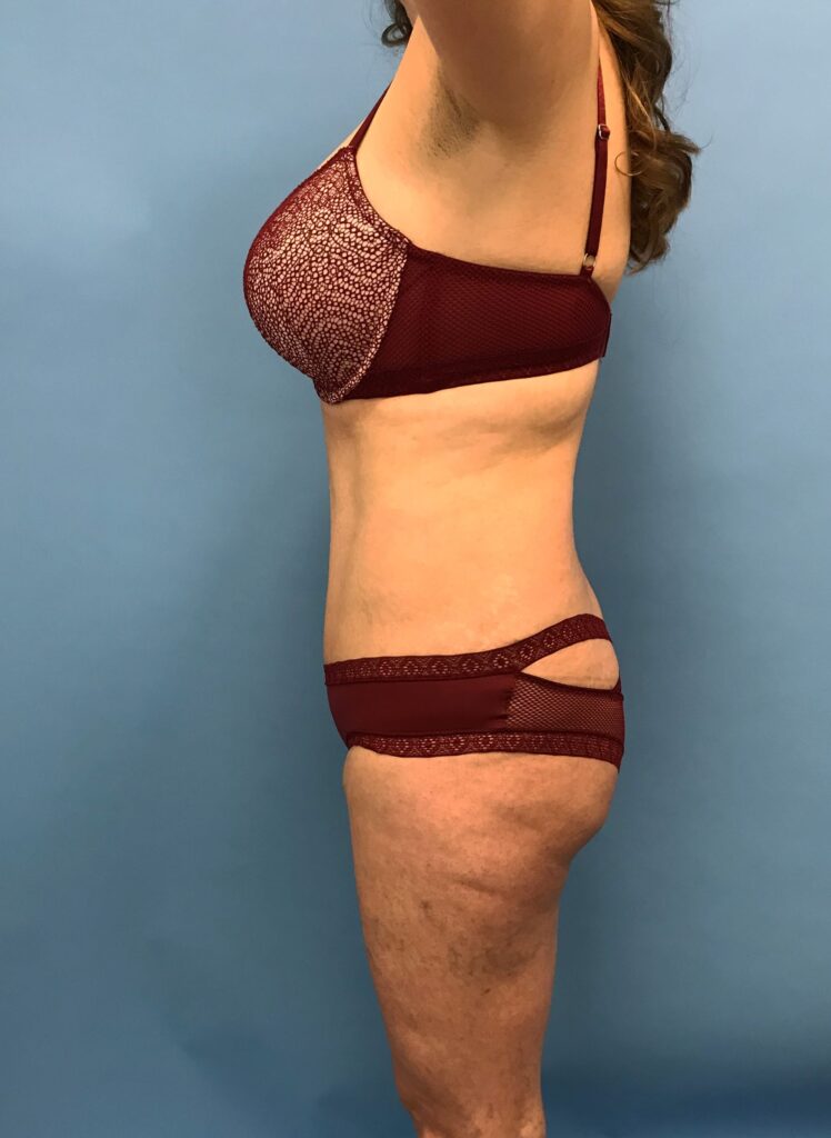 Case TTK-0484 after photo — Dr. Cat, Beverly Hills