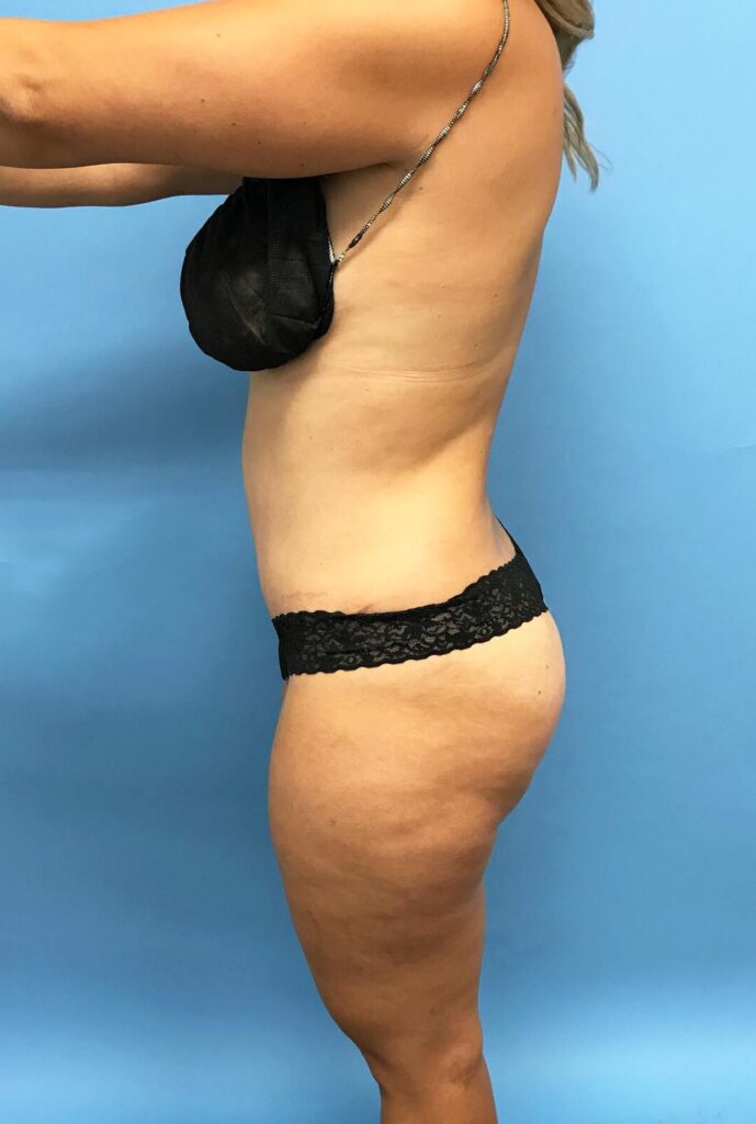 Case TTK-0449 after photo — Dr. Cat, Beverly Hills