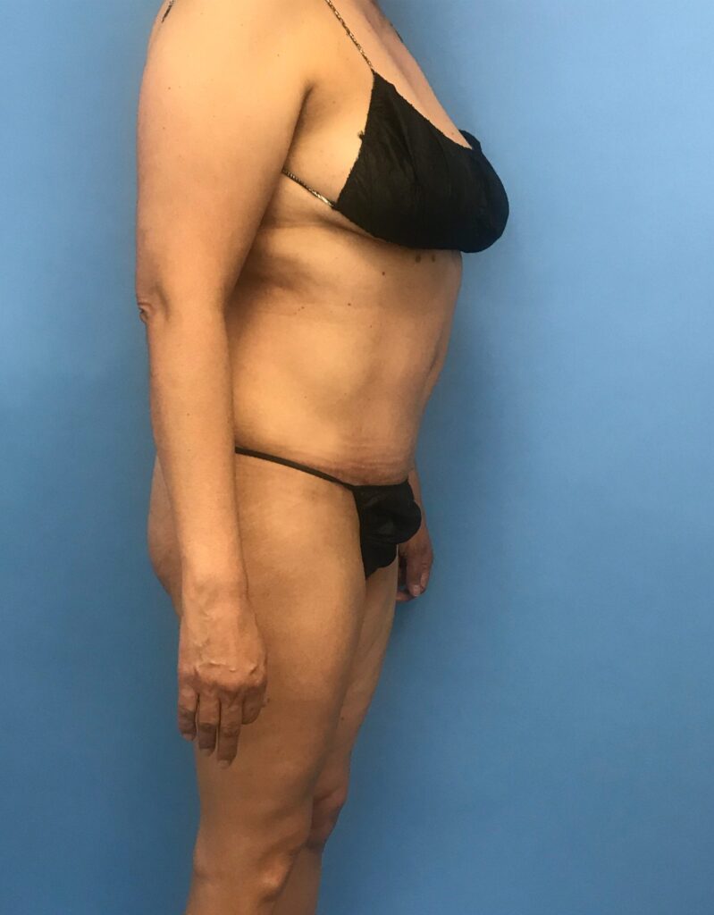 Case RTK-0528 after photo — Dr. Cat, Beverly Hills