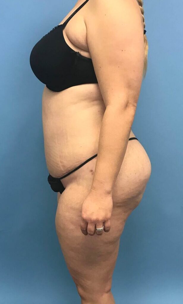 Case TTK-0493 after photo — Dr. Cat, Beverly Hills