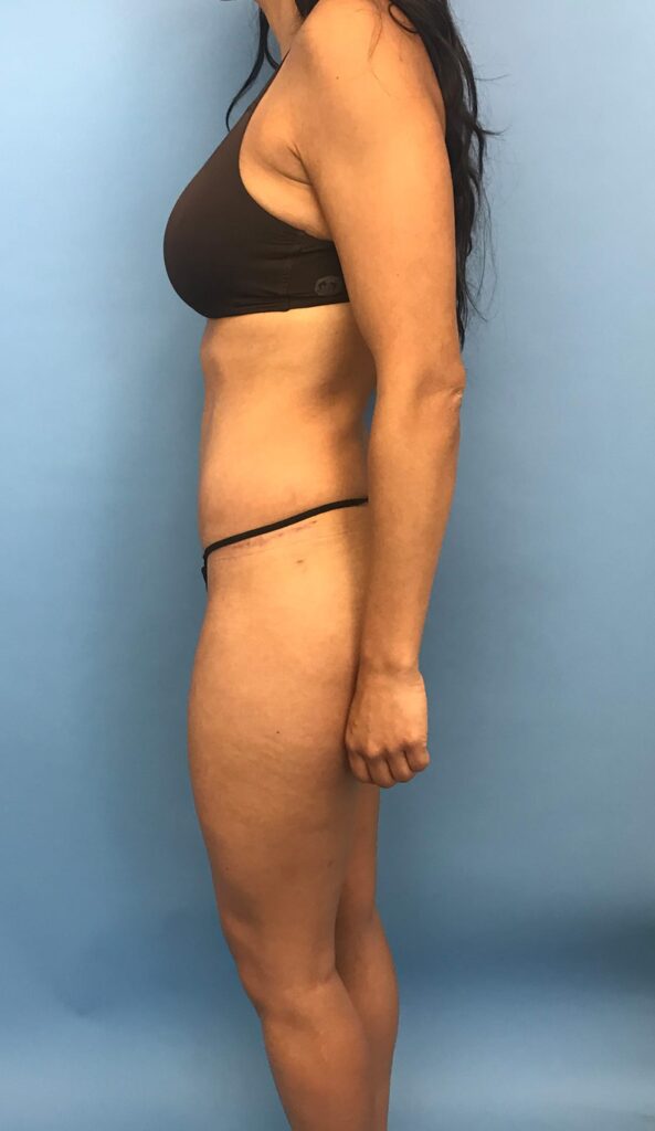 Case TTK-0506 after photo — Dr. Cat, Beverly Hills