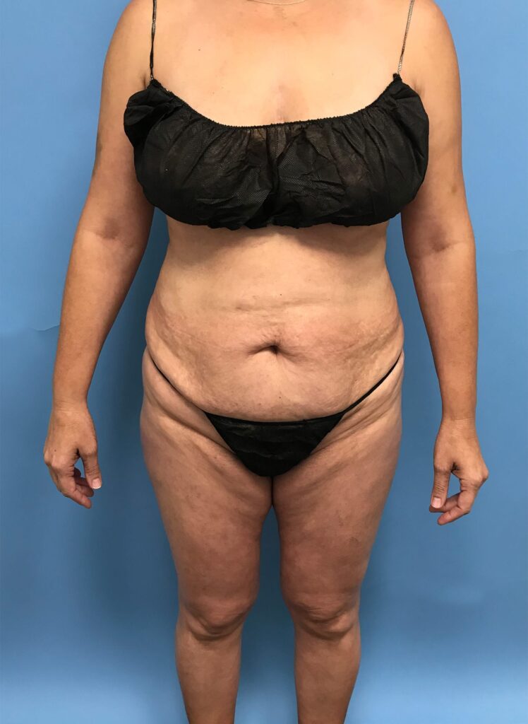 Case TTK-0484 before photo — Dr. Cat, Beverly Hills
