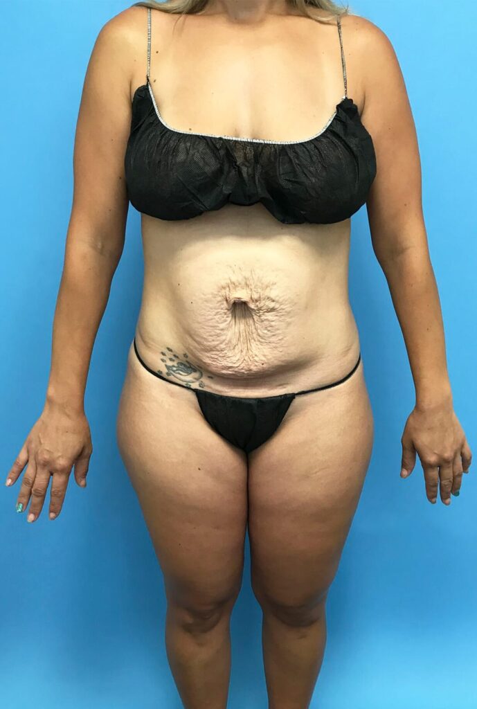 Case TTK-0449 before photo — Dr. Cat, Beverly Hills