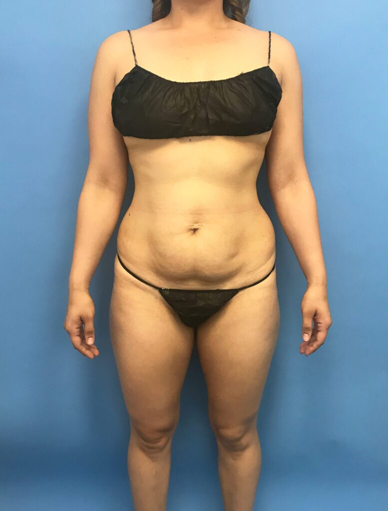 Case TTK-0548 before photo — Dr. Cat, Beverly Hills