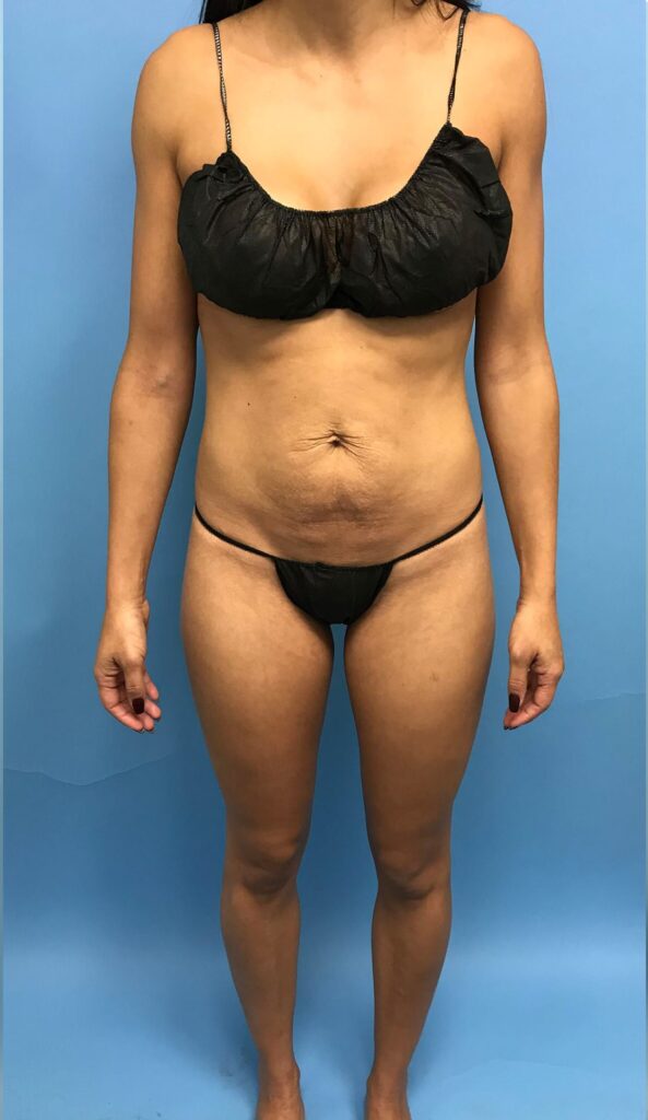 Case TTK-0506 before photo — Dr. Cat, Beverly Hills