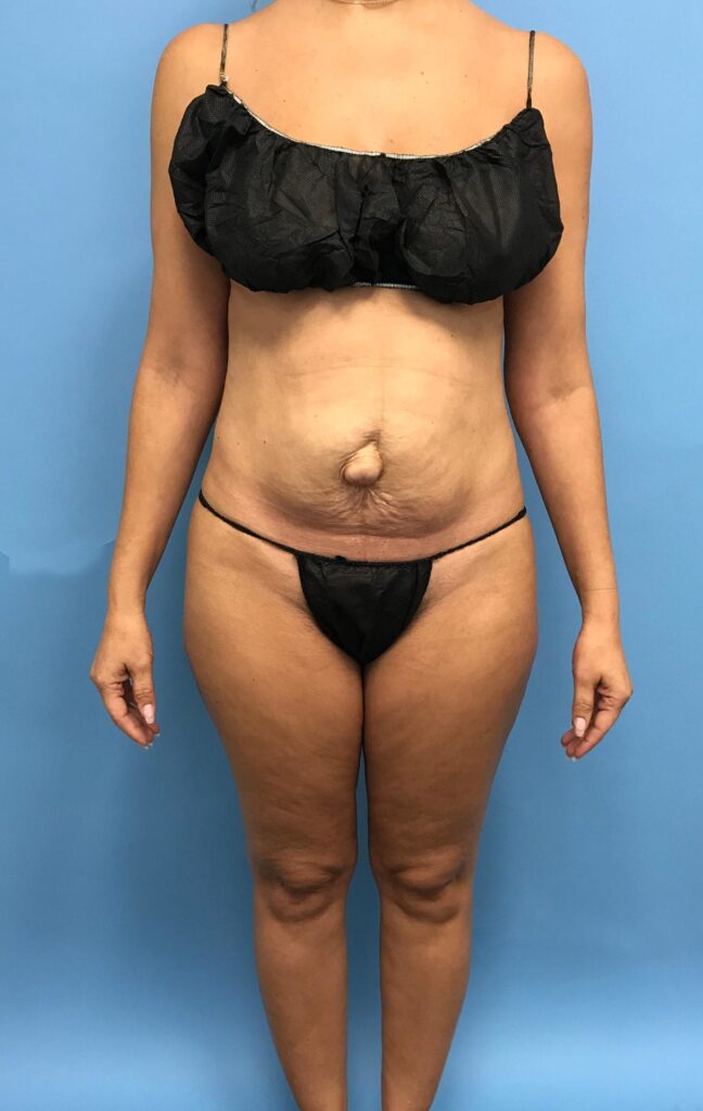 Case TTK-0488 before photo — Dr. Cat, Beverly Hills