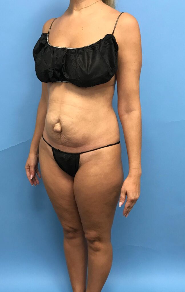 Case TTK-0488 before photo — Dr. Cat, Beverly Hills
