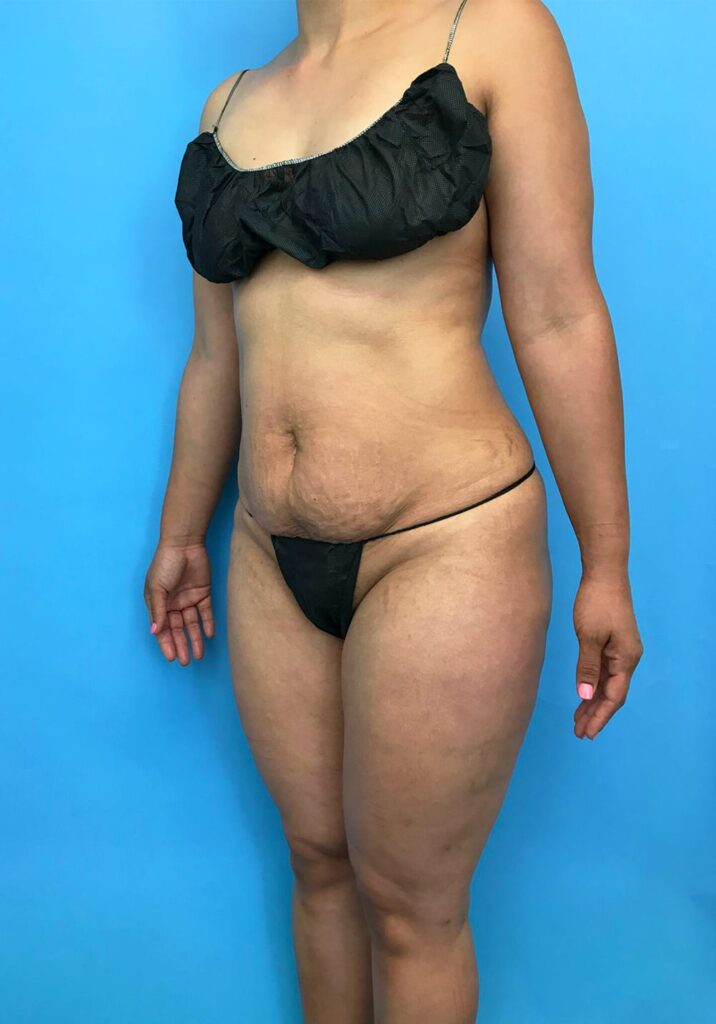 Case TTK-0440 before photo — Dr. Cat, Beverly Hills