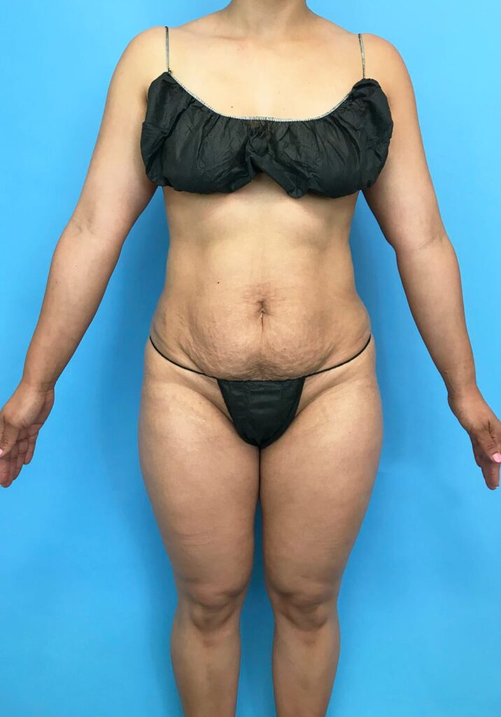 Case TTK-0440 before photo — Dr. Cat, Beverly Hills