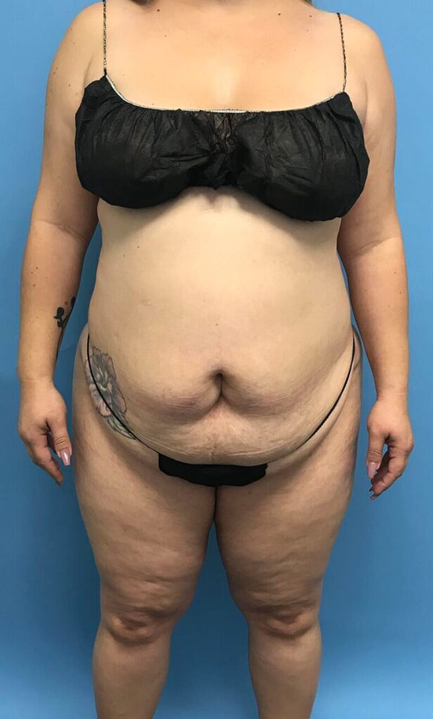 Case TTK-0493 before photo — Dr. Cat, Beverly Hills