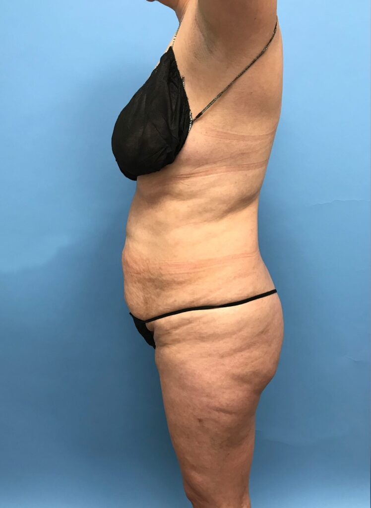 Case TTK-0484 before photo — Dr. Cat, Beverly Hills