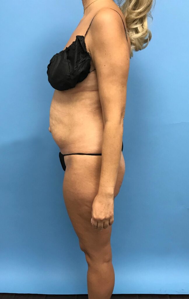 Case TTK-0488 before photo — Dr. Cat, Beverly Hills