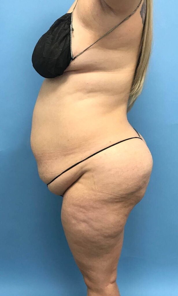 Case TTK-0493 before photo — Dr. Cat, Beverly Hills
