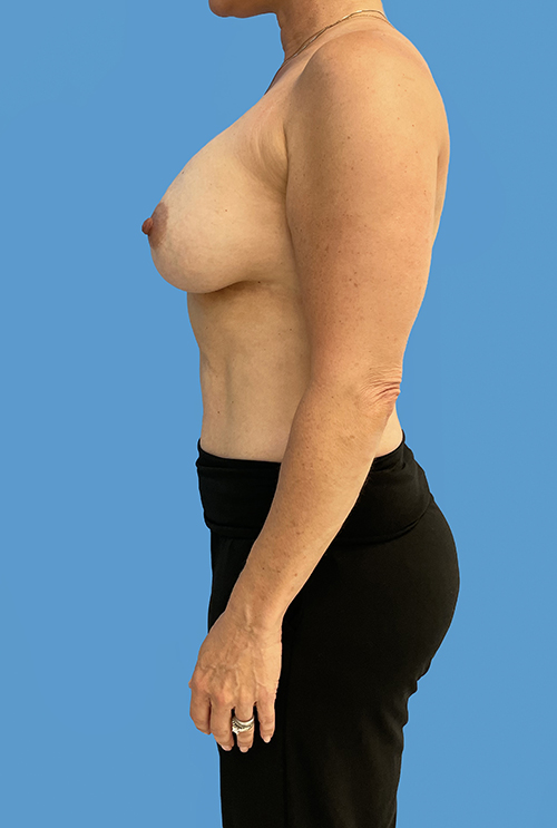 Breast Augmentation after photo profile view - Dr. Cat Beverly Hills
