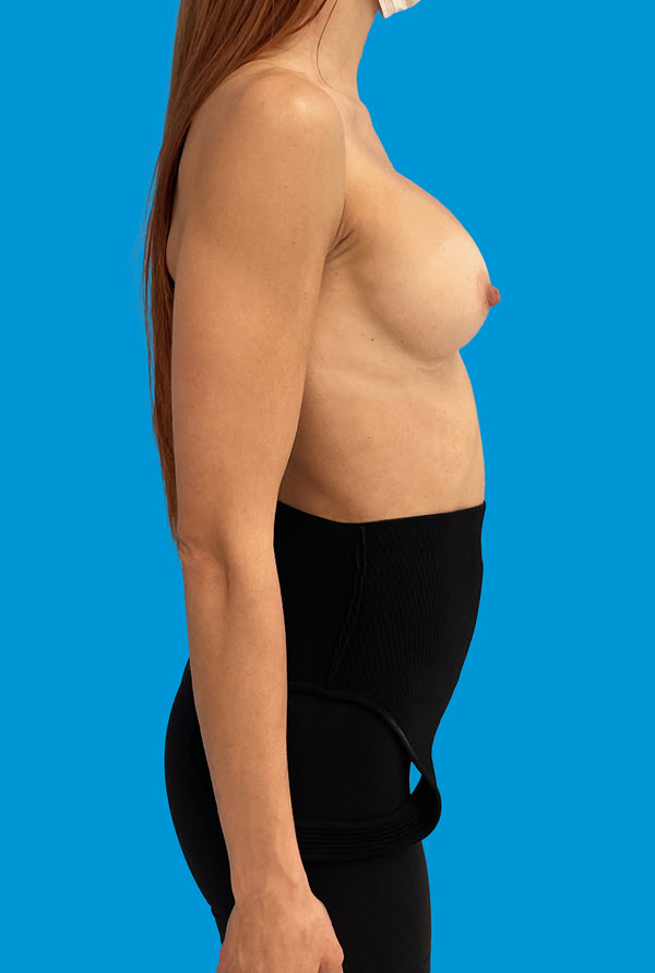 Breast Revision before photo profile view - Dr. Cat Beverly Hills