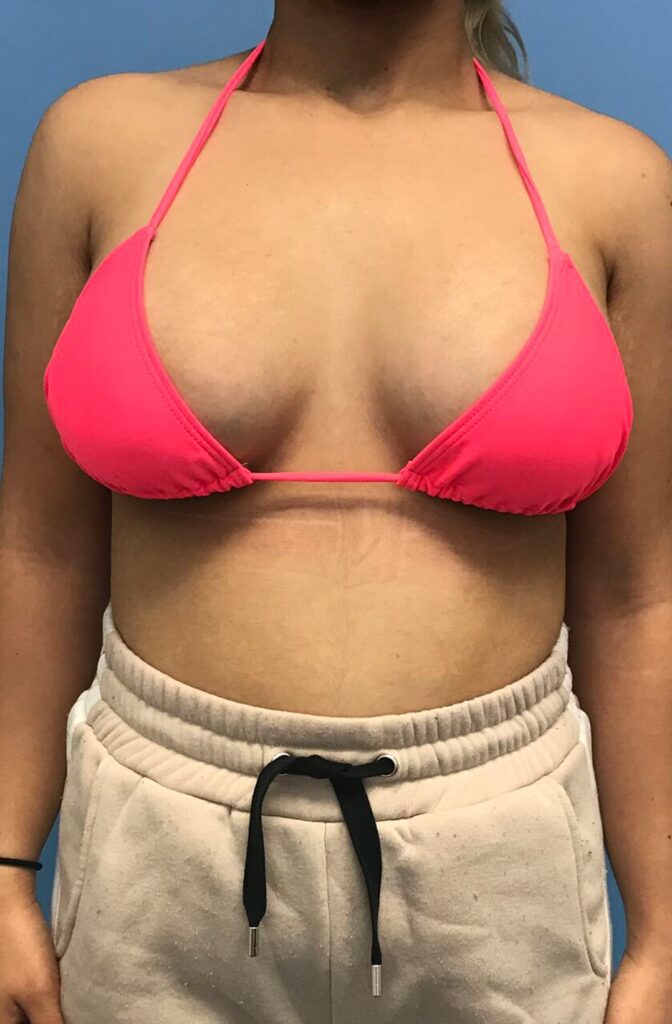 Case BAI-0382 after photo — Dr. Cat, Beverly Hills
