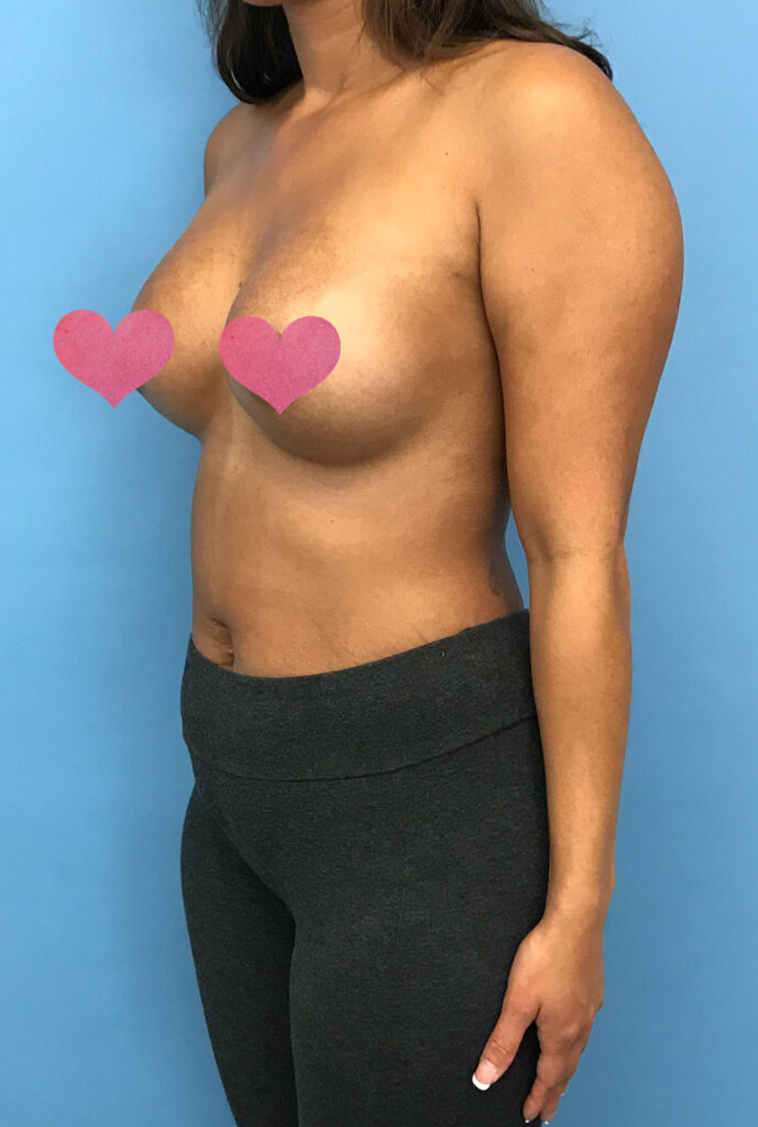Case BAI-0423 after photo — Dr. Cat, Beverly Hills